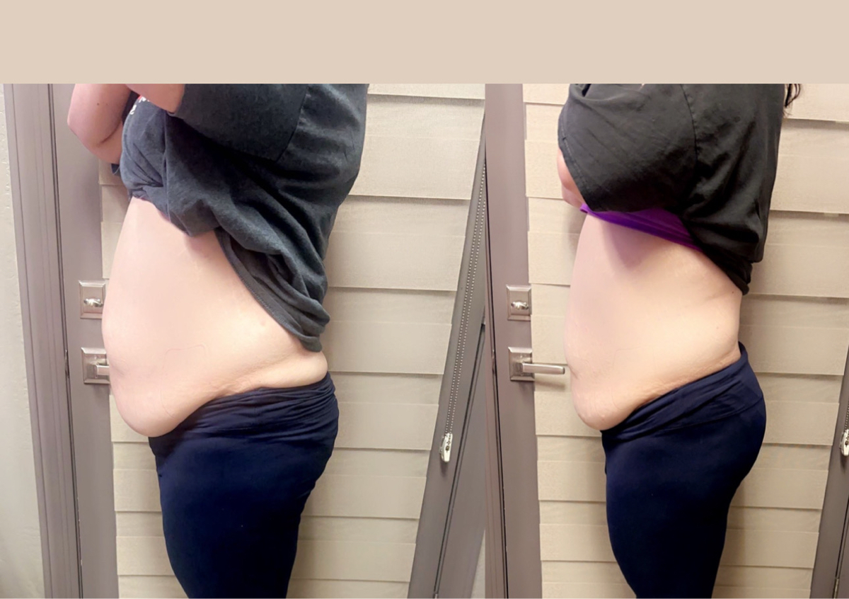 Lipo shots ALL OVER abdomen includes free lipo cavitation
